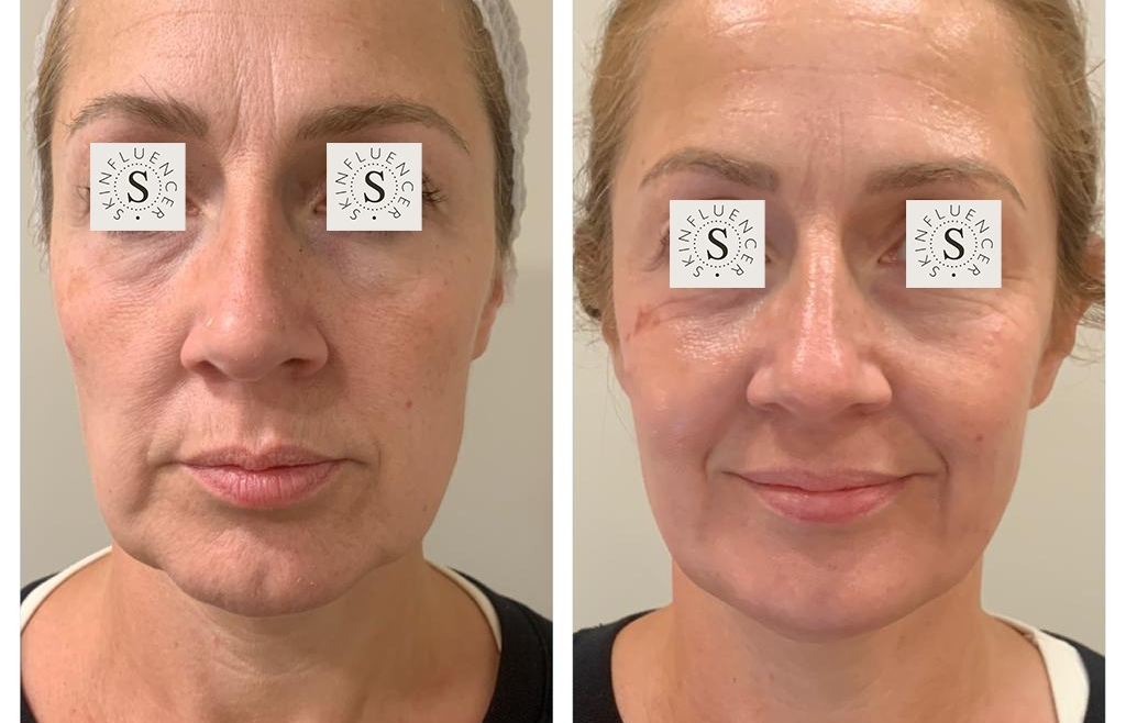 Face Tightening Laser Treatment in London Skinfluencer