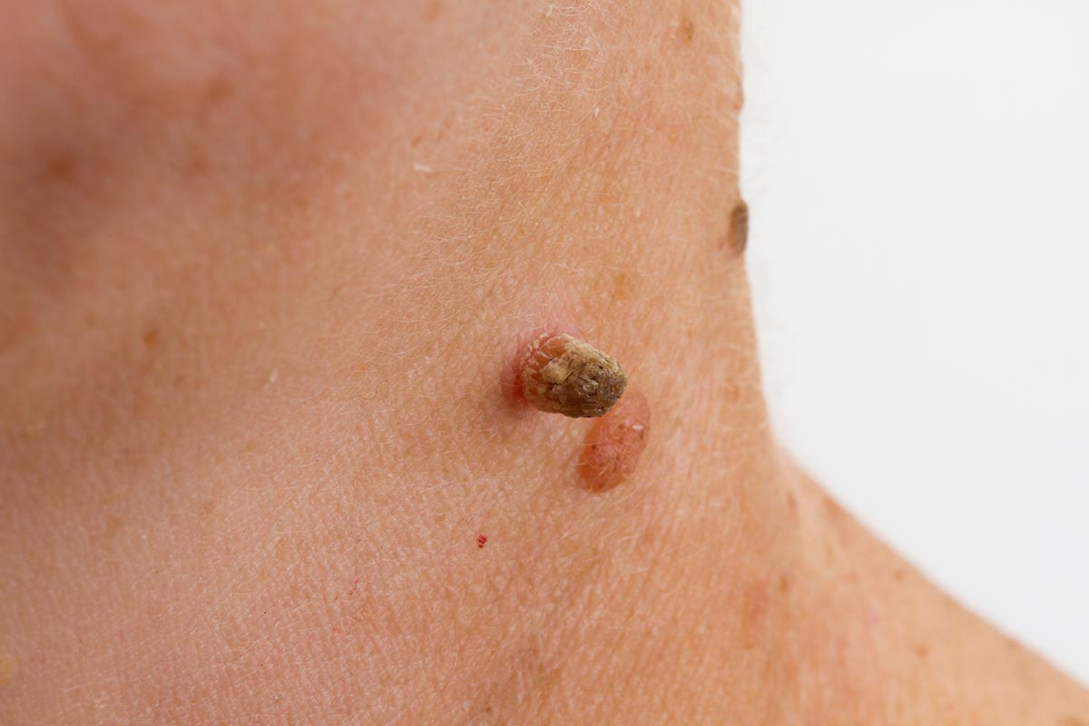 Benign Moles Warts Lesions Veins 
